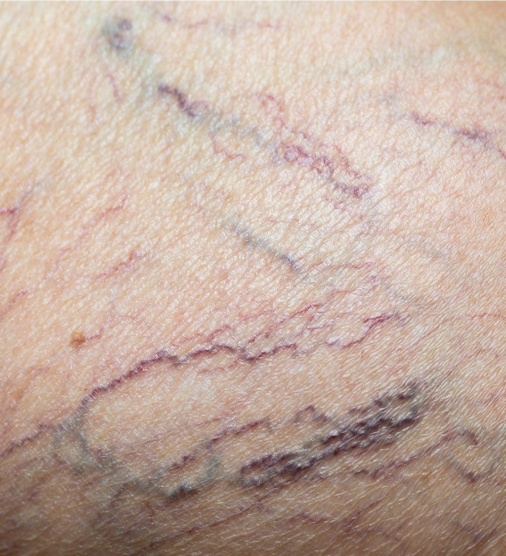 Spider Veins, Wine Stains, Leg Veins